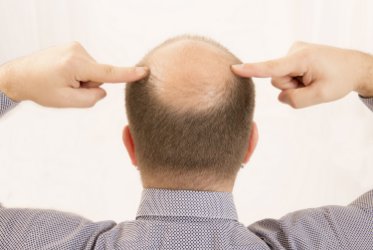 Injerto capilar: la solución quirúrgica para recuperar tu cabello