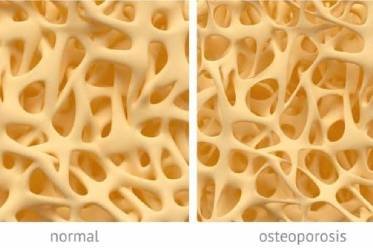 Osteoporosis: diagnóstico y tratamiento