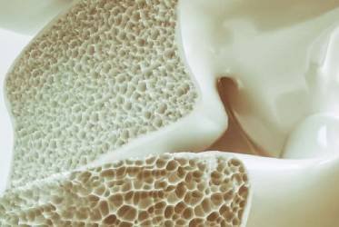 Osteoporosis: qué es, síntomas y cómo prevenirla